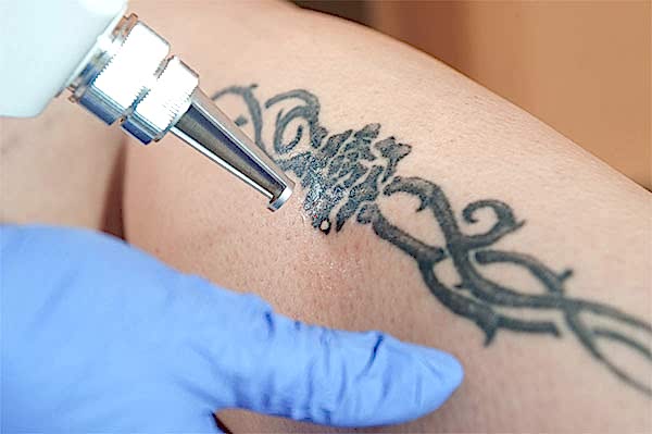 lazerle dövme silme