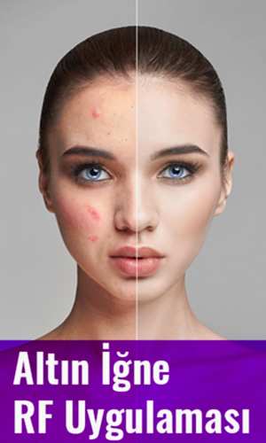 Altın İğne RF Uygulaması