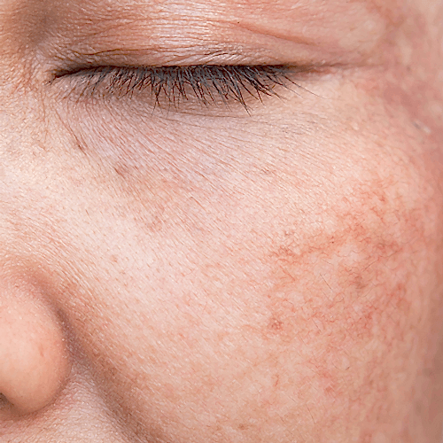 Lazerle Çil Tedavisi