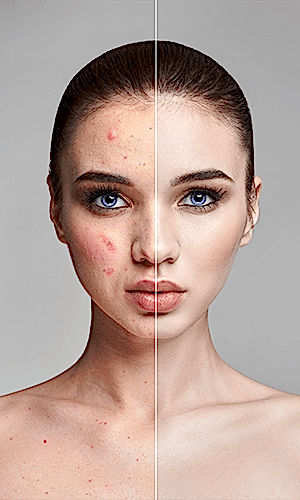 Lazerle Akne İzleri ve Sivilce Lekeleri Tedavisi