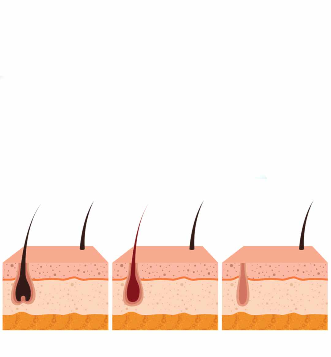 Erkek Lazer Epilasyon Nasıl Yapılır?