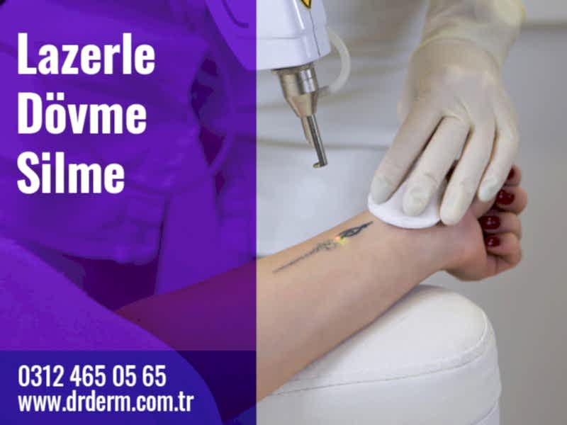 Lazerle Dövme Silme