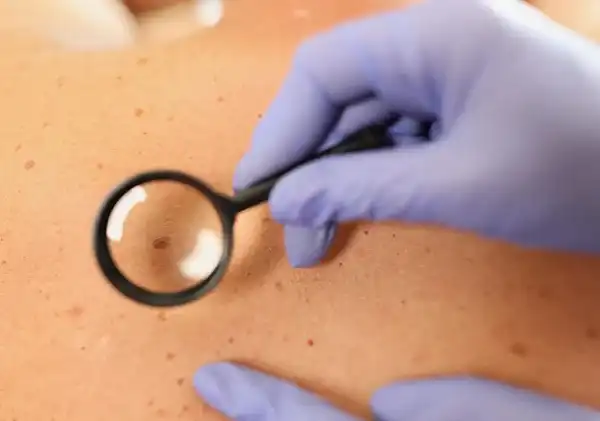 Lazerle Ben Alma Ankara